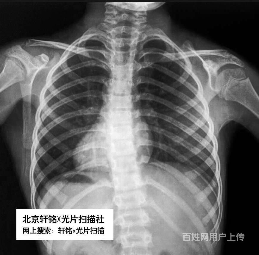 x光片扫描 3亿像素高清扫描ct胶片 刘轩铭扫描社