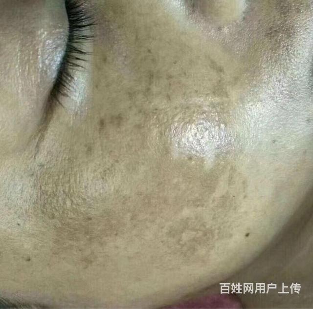 什么是黄褐斑?