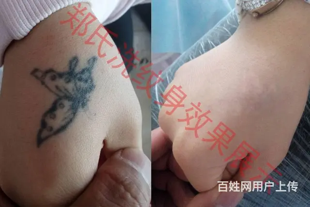 沈阳洗纹身郑氏洗纹身一次洗净纹身签合同包洗所有纹身 - 图片 11