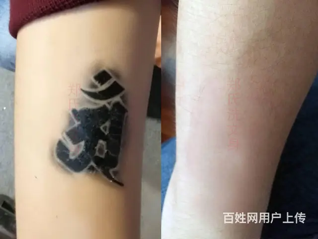 洗不掉的纹身就到郑氏洗纹身工作室 - 图片 3