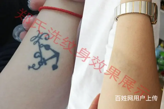 纹身洗不掉就到辽阳郑氏洗纹身专洗别处洗不掉所有纹身 - 图片 7
