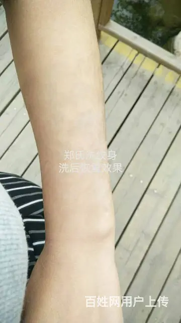 小女生洗纹身失败再纹身遮盖 后彻底洗掉纹身 - 图片 5