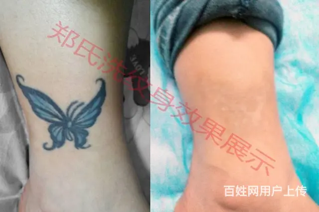 吉林长春四平洗不掉纹身到辽阳郑氏洗纹身签合同包洗掉 - 图片 3