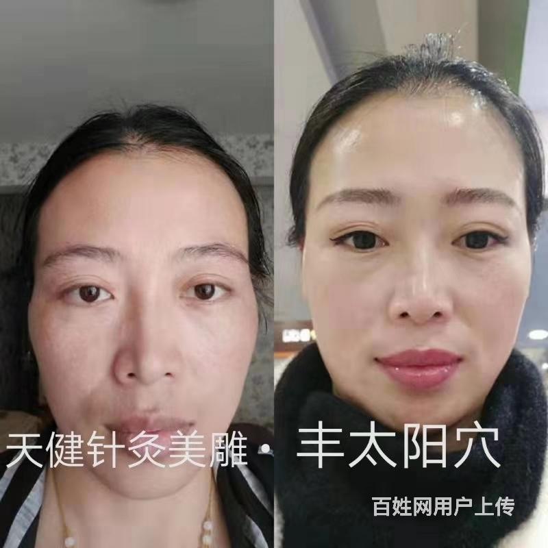 黄石针灸微整形美雕培训