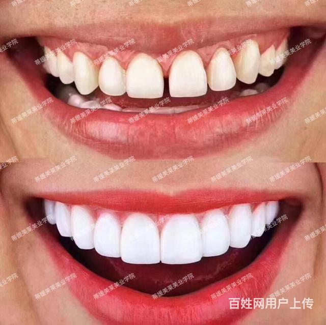 蒂媛激光美白牙齿培训学校有哪些学费多少