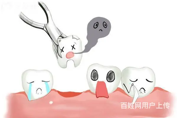 别急！拔牙当天种牙需谨慎，关键注意事项一览 - 图片 1