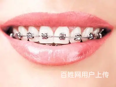 哈尔滨牙医告诉你：成人做牙齿矫正还有效果吗 - 图片 1