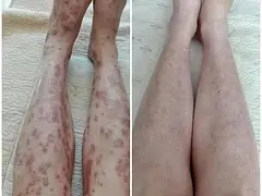 牛皮皮皮皮癣看过来
