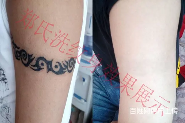 纹身洗不掉就到辽阳郑氏洗纹身专洗别处洗不掉所有纹身 - 图片 4