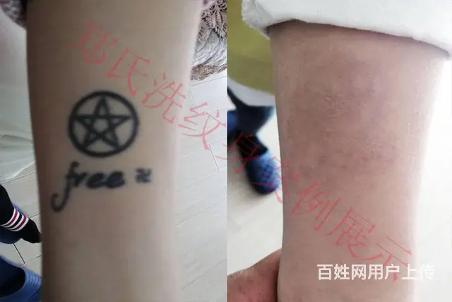 沈阳洗纹身专洗别处洗不掉的所有纹身郑氏洗纹身包洗净 - 图片 9