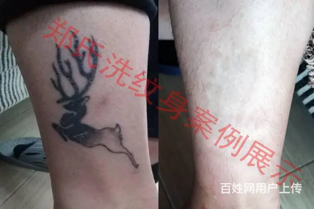 沈阳洗纹身就到辽阳郑氏洗纹身专洗别处洗不掉的纹身 - 图片 9