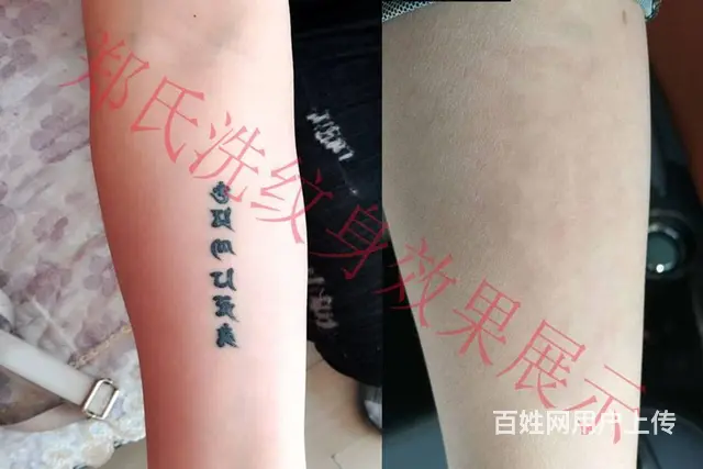 沈阳洗纹身就到辽阳郑氏洗纹身专洗别处洗不掉的纹身 - 图片 2