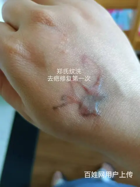 郑氏洗纹身工作室助力小美女摆脱疤痕增生 - 图片 1