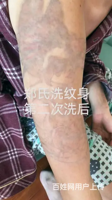 洗纹身还是郑氏洗纹身工作室可靠 - 图片 3