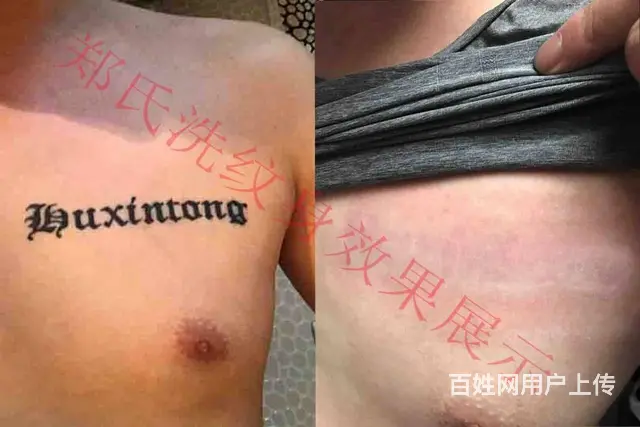 沈阳洗纹身郑氏洗纹身一次洗净纹身签合同包洗所有纹身 - 图片 6