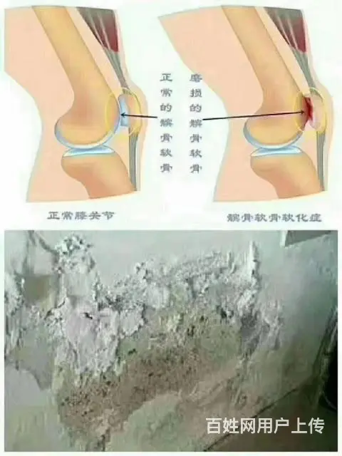 髌骨软化是怎么回事？该怎么办？ - 图片 1