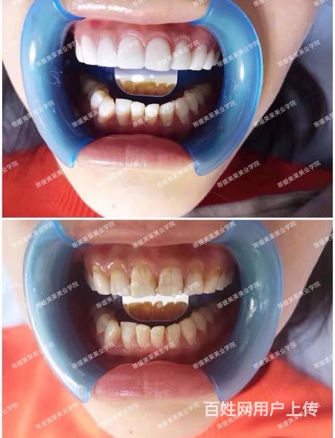 激光美白牙齿培训美牙培训学校学费多少选蒂媛