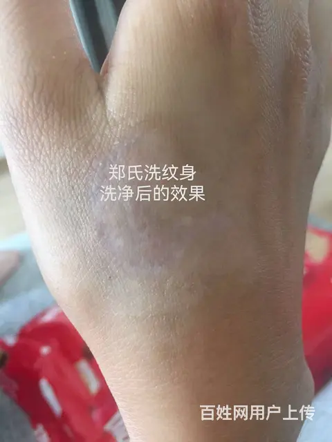 美女小雅洗净虎口纹身感谢郑氏洗纹身工作室 - 图片 3