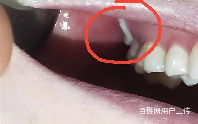 智齿一定要拔掉吗，看看哈尔滨牙医怎么说 - 图片 2