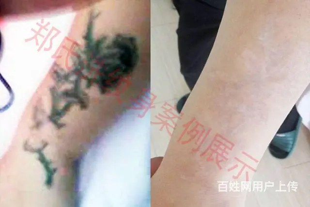 沈阳洗纹身一次性洗纹身签合同包洗所有纹身郑氏洗纹身 - 图片 10