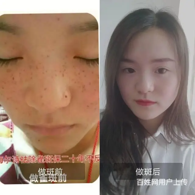 美容祛斑 - 图片 6
