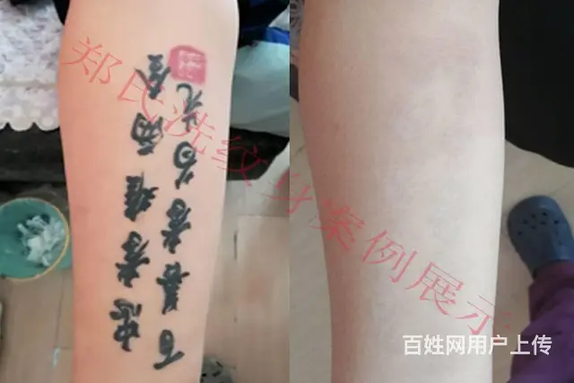吉林长春四平洗不掉纹身到辽阳郑氏洗纹身签合同包洗掉 - 图片 2