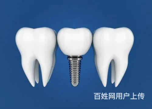 想换新牙？看这里！哈尔滨进口种植牙费用一览无余 - 图片 2