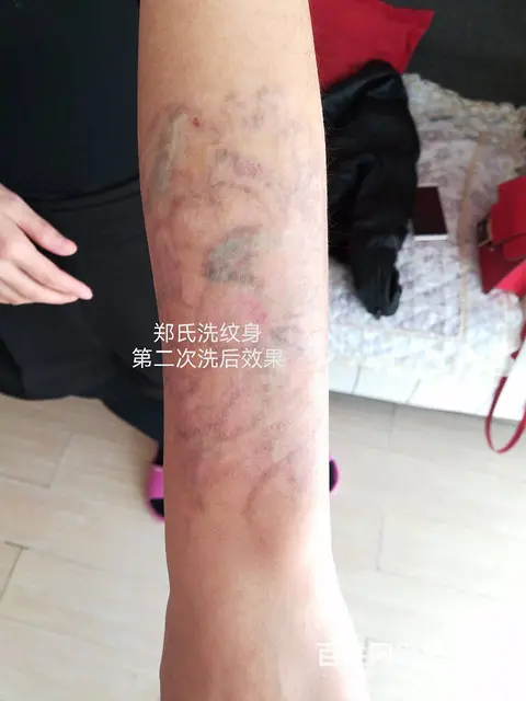 洗纹身失败后纹一个更大彩色纹身遮盖还能洗掉吗 - 图片 3