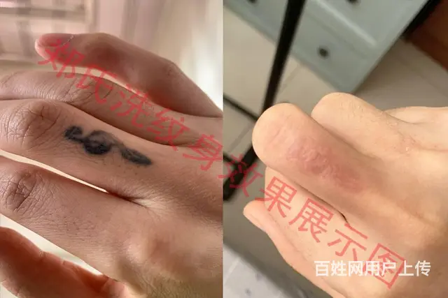 沈阳洗纹身一次性洗净纹身郑氏洗纹身承接别处洗不掉的 - 图片 3