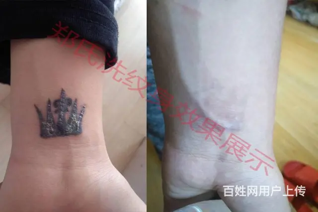 纹身洗不掉就到辽阳郑氏洗纹身专洗别处洗不掉所有纹身 - 图片 11