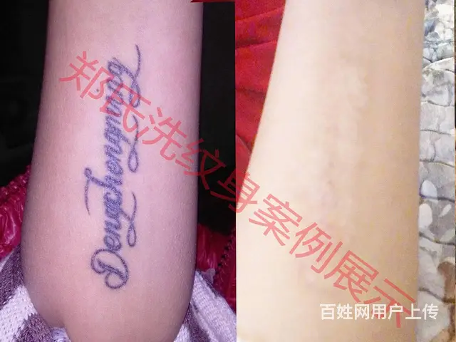 沈阳洗纹身郑氏纹洗只做洗纹身因为专注所以专业包洗掉 - 图片 12