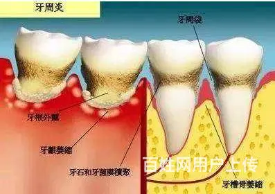 牙齿的隐形杀手：了解牙周炎与牙髓炎的秘密差异 - 图片 1