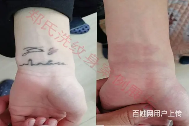 沈阳洗纹身就到辽阳郑氏洗纹身专洗别处洗不掉的纹身 - 图片 6