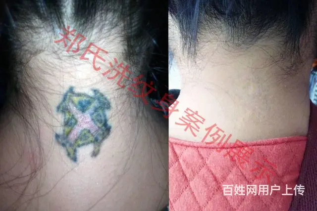 洗纹身哪家好辽阳郑氏洗纹身专业技术签合同包洗效果好 - 图片 2