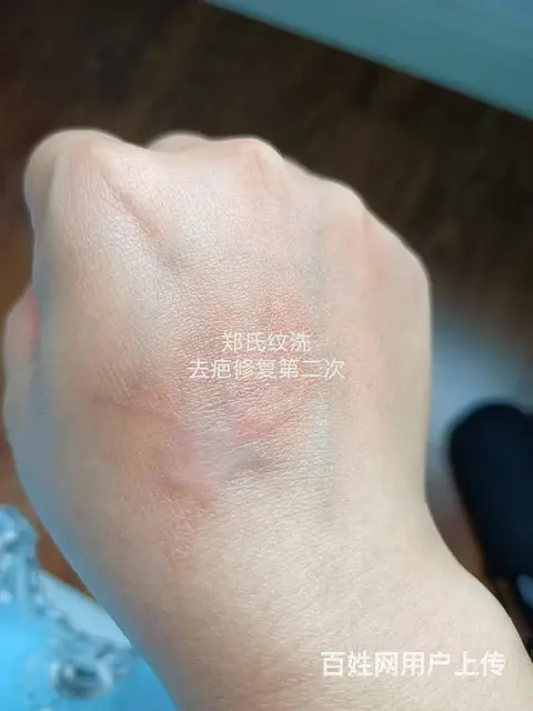 郑氏洗纹身工作室助力小美女摆脱疤痕增生 - 图片 2
