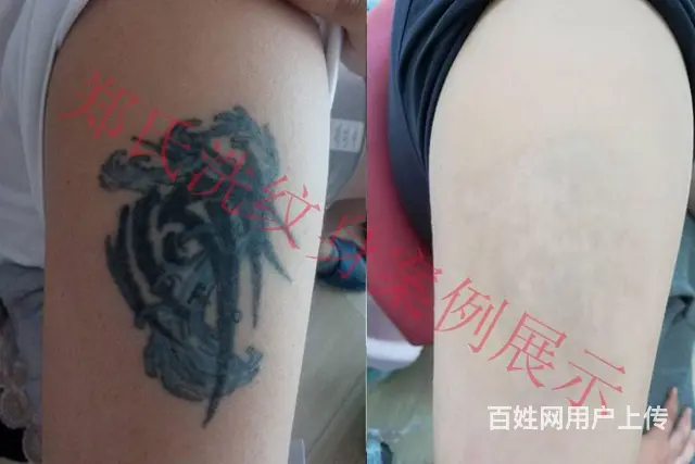 北京天津洗不掉的纹身到辽阳郑氏洗纹身签合同包洗干净 - 图片 2