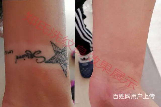 洗纹身就到辽阳郑氏洗纹身专洗别处洗不掉的所有纹身 - 图片 7