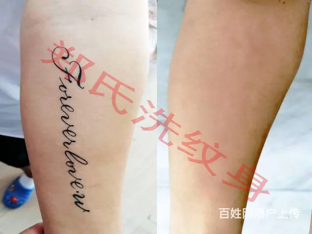 沈阳北京上海洗不掉纹身到辽阳郑氏洗纹身签合同包洗掉 - 图片 7