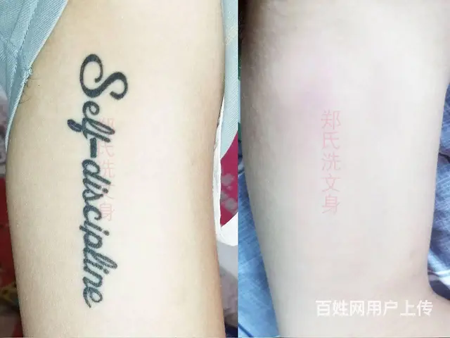 洗纹身洗不掉到郑氏洗纹身工作室 - 图片 10