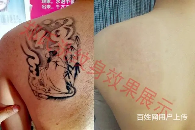 沈阳洗纹身就到辽阳郑氏洗纹身专洗别处洗不掉的纹身 - 图片 5