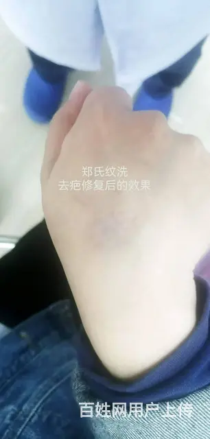 郑氏洗纹身工作室助力小美女摆脱疤痕增生 - 图片 3