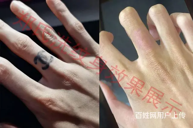 沈阳洗纹身郑氏洗纹身承接别处洗不掉的所有纹身包洗净 - 图片 5