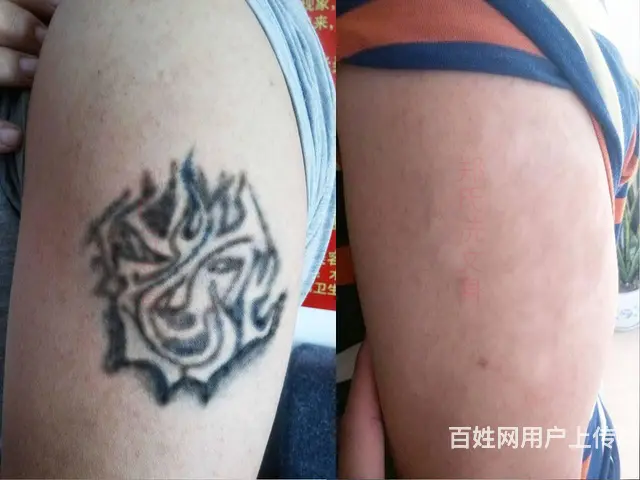 药水洗文身有效吗 - 图片 8