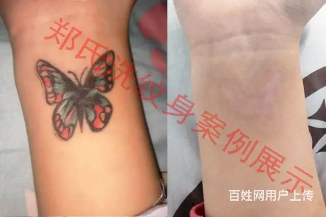 洗纹身就到辽阳郑氏洗纹身专洗别处洗不掉的所有纹身 - 图片 5